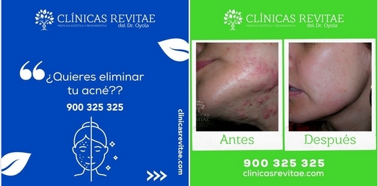 ¿LLEVAS MUCHOS AÑOS LUCHANDO CONTRA LAS CICATRICES DE ACNÉ?